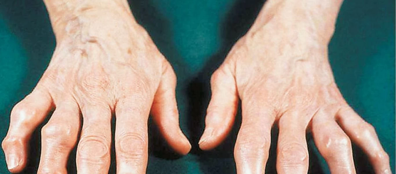 Οι 5+1 τροφές που πρέπει να αποφεύγουν όσοι πάσχουν από αρθρίτιδα